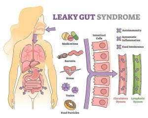 Leaky Gut Syndrome Causes Psoriasis to Get Worse