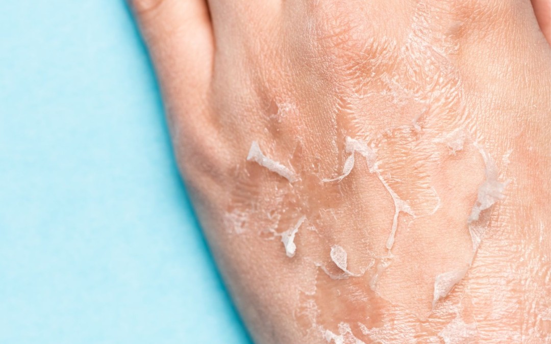 How To Heal and Repair Over-Exfoliated Skin